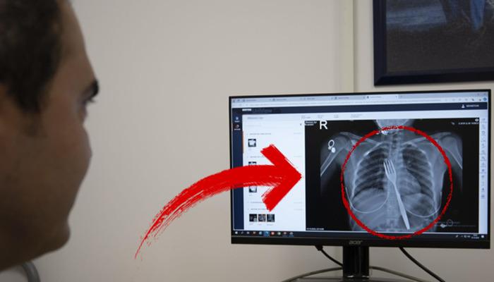 Aydın'da olağanüstü vaka: 18 santimetrelik çatalı yuttu, doktorları şaşırttı! Bilimsel bir makaleye konu olacak...